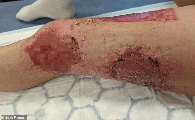 Dejados con quemaduras severas y piel rezumadora, la Sra. Absolom fue trasladada al hospital para un tratamiento extenso (en la foto: la pierna quemada de la Sra. Absolom)