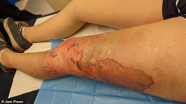 La Sra. Absolom se sometió a un injerto de piel, pero la recuperación no fue fácil, con tareas diarias como meterse en la ducha causando su dolor (en la foto: la quemadura de la Sra. Absolom)