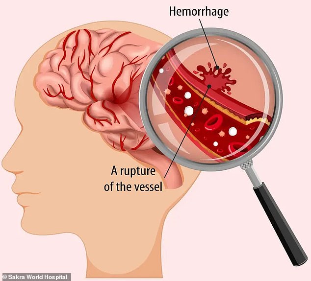 Una hemorragia cerebral, también conocida como hemorragia cerebral, es una condición potencialmente mortal que ocurre cuando hay sangrado en el cerebro